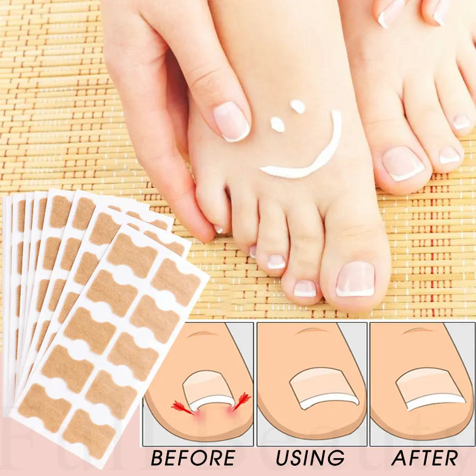 Ingrown Toenail Patches (100 pcs)